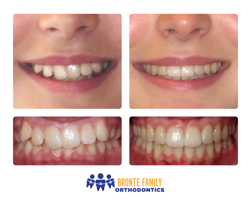 Crooked Teeth Before And After Invisalign - Goimages EO
