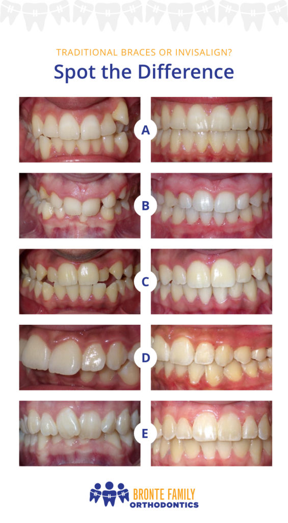 Braces vs. Invisalign, Leber Orthodontics